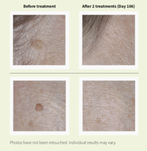 Eskata Treatment Before and After