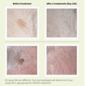 ESKATA treatment before and after