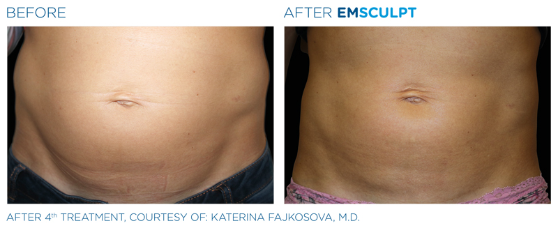 emsculpt muscle before and after