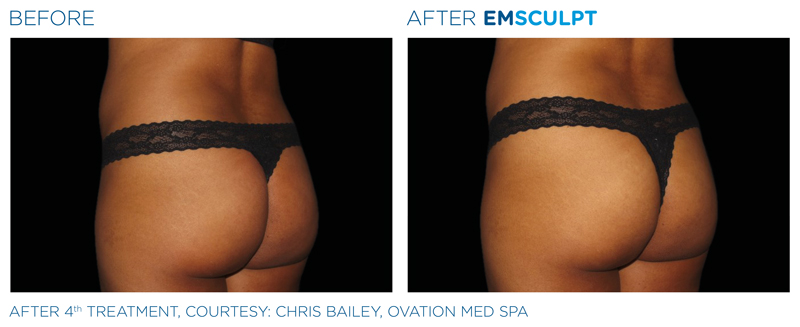 emsculpt female before and after