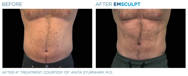 emsculpt before and after photo