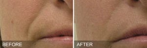 hydrafacial patient