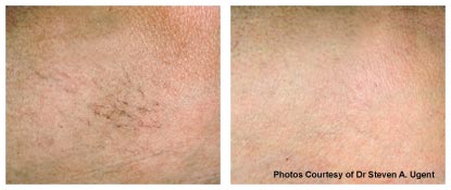 vein treatment before and after