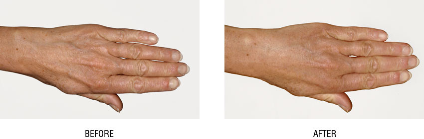 hand rejuvenation before and after