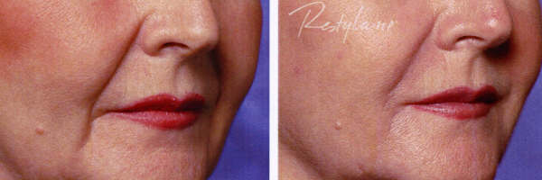marionette lines before and after