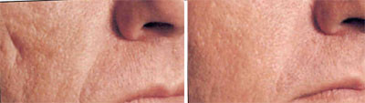 dermal fillers before and after