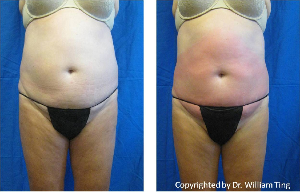 liposuction before and after