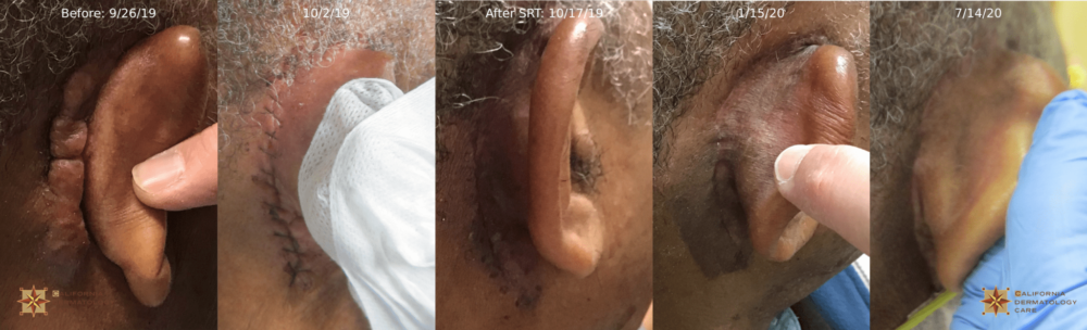 keloid repair before and after