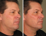 ultherapy before and after