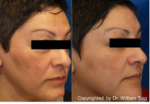 melasma treatment before and after