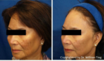 melasma treatment before and after