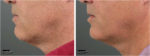 ultherapy before and after