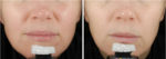 ultherapy before and after