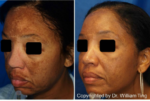 melasma treatment before and after