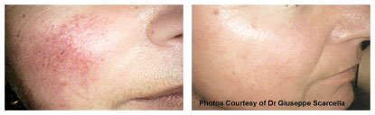 VBeam Before & After Photos San Ramon Dr. William Ting