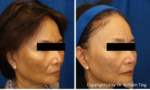 melasma treatment before and after