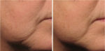 ultherapy before and after