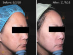 melasma treatment before and after