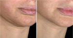 ultherapy before and after