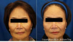 melasma treatment before and after