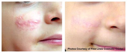 VBeam Before & After Photos San Ramon Dr. William Ting