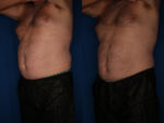 coolsculpting before and after