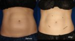 coolsculpting before and after