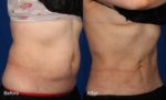 coolsculpting before and after