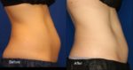 coolsculpting before and after