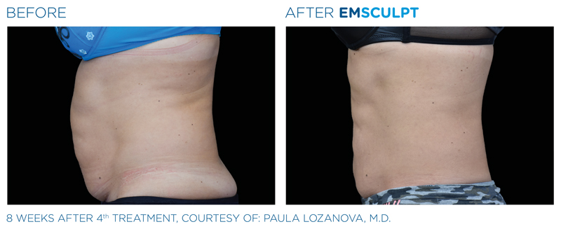 emsculpt before and after abs