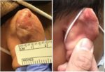 Before and After photos of a keloid treated with shave excision and SRT