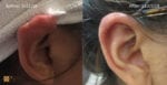 keloid treatment before and after