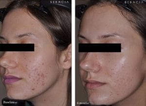 acne treatment before and after