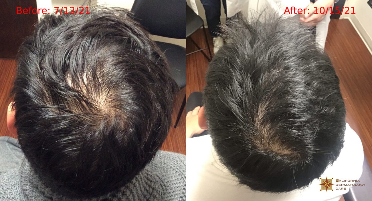 prp hair restoration before and after