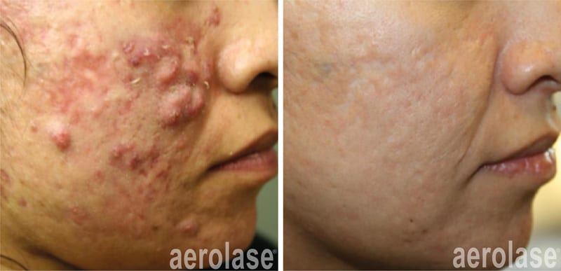 Aerolase before and after