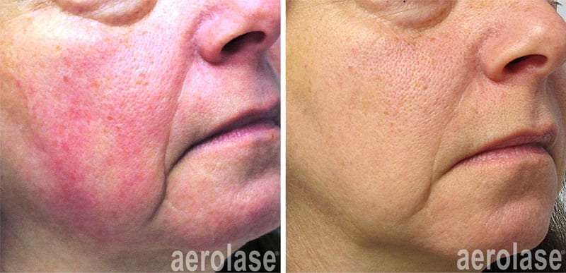 Aerolase before and after