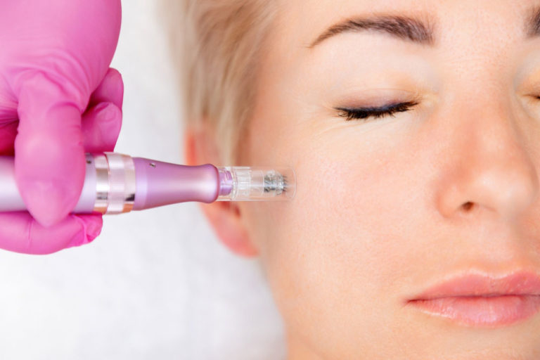 subnovii plasma pen vs microneedling